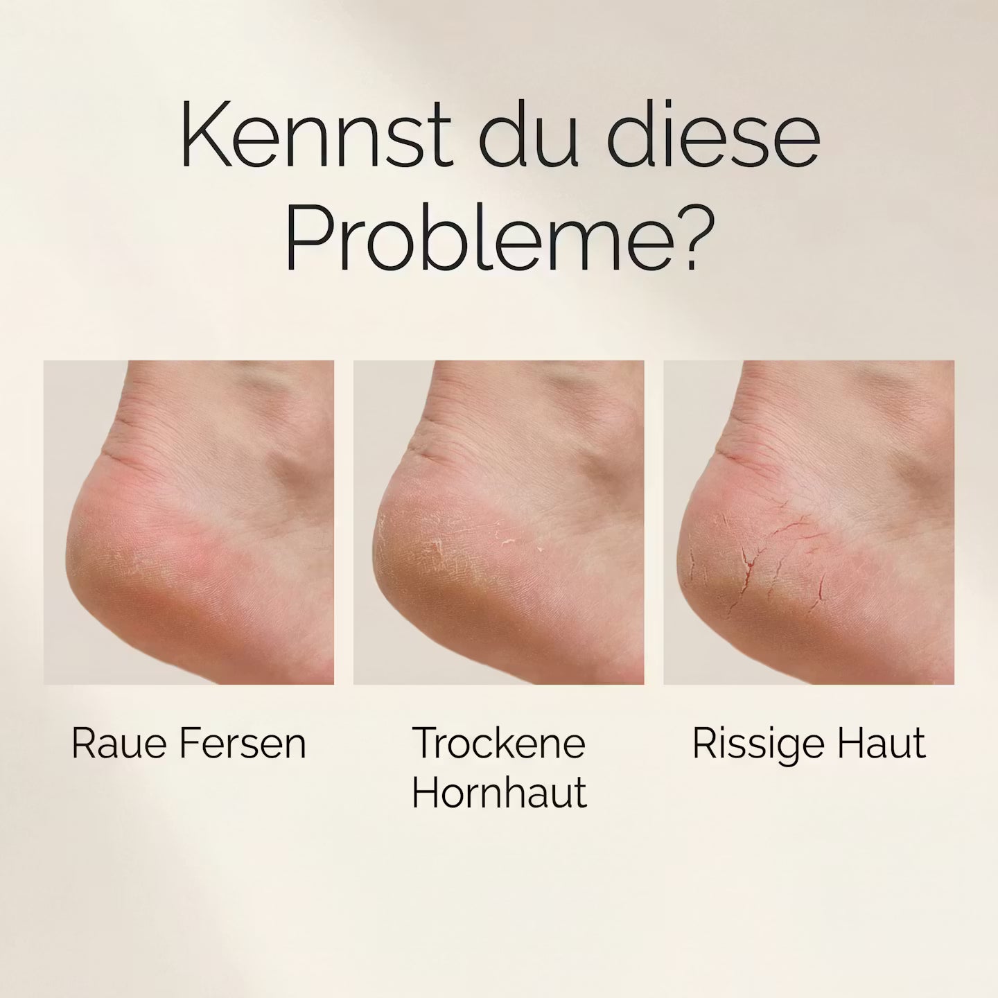 Elektrischer Hornhautentferner